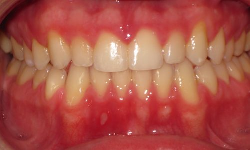 close up of teeth - orthodontic surgery - Avery Eikost after
