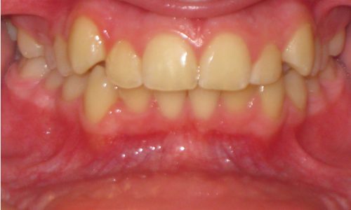 close up of teeth - orthodontic surgery - Hailey Fulton before