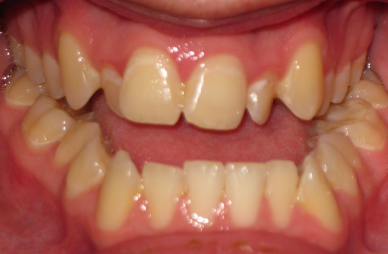 Marietta Surgical Orthodontics Kennesaw Jaw Misalignment Correction