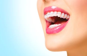 Orthodontics Marietta GA, 