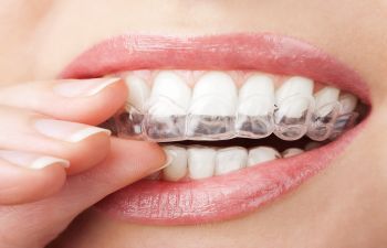 🥇 Advantages of Clear Aligner Braces