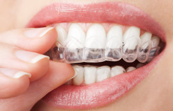 woman puts on invisalign close up on lips, 